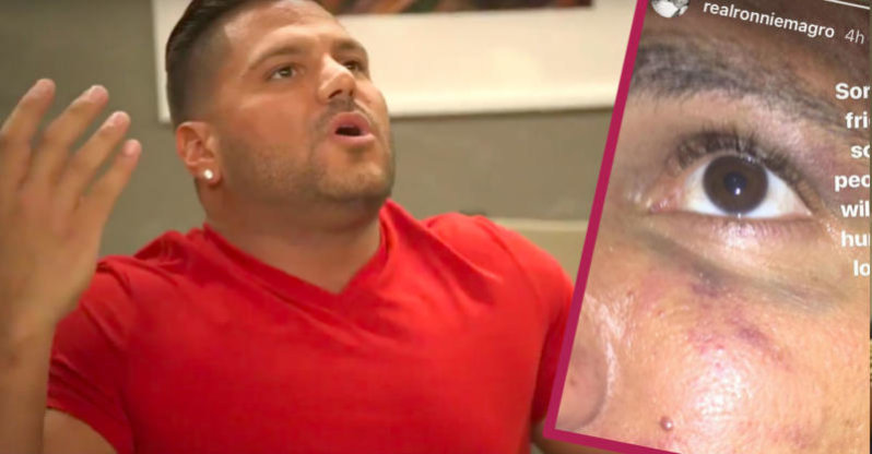 The Real Story Behind Ronnie Ortiz-Magro’s Black Eye